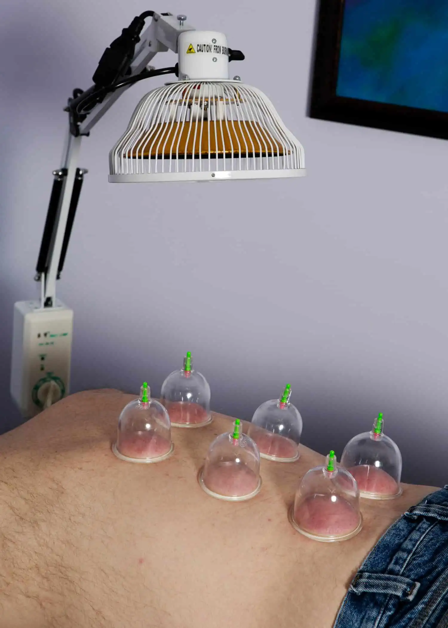 Cupping